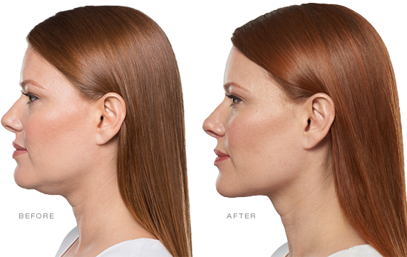 Before and After Kybella to get rid of a double chin