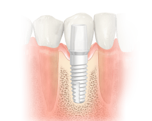 image of a ceramic dental implant